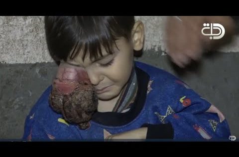 #مرض نادر يثقل كاهل طفل في بابل !!