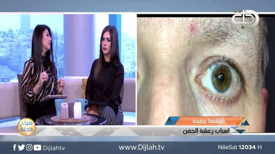 لمعرفة أسباب رعشة الجفن…شاهد الفيديو