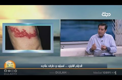 الحزام الناري اسبابه وطرق علاجه مع الدكتور احسان فهمي الشنطي