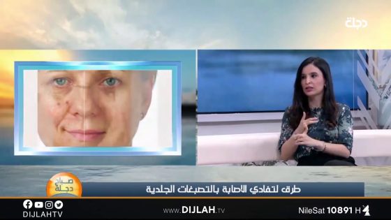 تعرف على الفرق بين الكلف والتصبغات الجلدية مع الدكتورة مروة النداوي