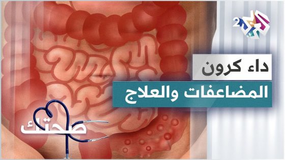 داء كرون .. الأسباب والمضاعفات والتشخيص والعلاجات المتوفرة