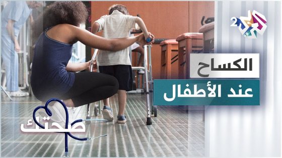 الكساح عند الأطفال .. الأسباب والأعراض وطرق العلاج