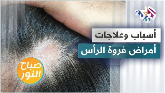 أمراض فروة الرأس .. الأسباب والأعراض وطرق العلاج